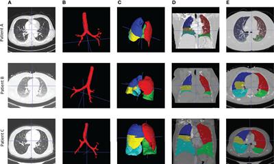 Imaging-Based Deep Graph Neural Networks for Survival Analysis in Early Stage Lung Cancer Using CT: A Multicenter Study